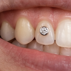 Dental Jewellery